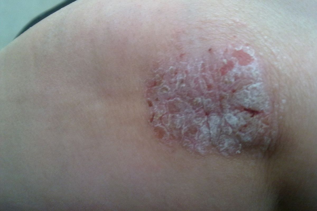 Why Psoriasis Gets Worse in Winter: 7 Triggers and How Ayurveda Calms Flares (2026)